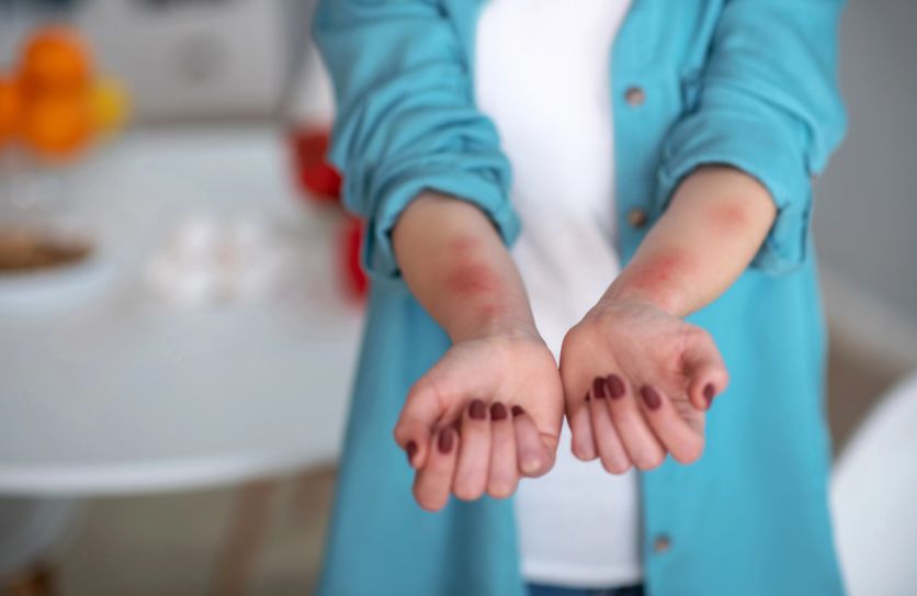 Дієта при кропивниці: що можна їсти, щоб шкіра знову «дихала»